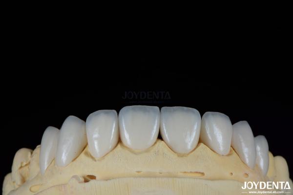 Long-lasting And Stain Resistant Dental Veneers With Personalized Shades For