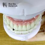 Metal Frame Titanium Malo Bridge Customizable Malo Implant Bridge