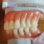Naturally Full Denture Acrylic Removable Full Dentures Customizable