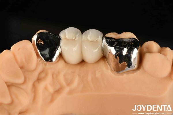 Buy cheap Metallic Dental Maryland Bonded Bridge Good Remediation For Oral Clinical Repair from wholesalers