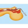 Buy cheap Medical Disposable Supplies Stainless Steel Laser Resistant Endotracheal Tube for Laser Larynx Surgeries from wholesalers