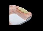 Natural Aesthetics Translucent Ceramic Crowns for Dental Restoration with Easy