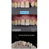 Buy cheap Resin Bonded Maryland Bridge Posterior Teeth for Regular Brushing Flossing product