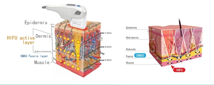 Portable design 11 lines 3D hifu machine face tight for beauty clinic use