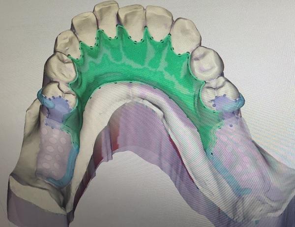 Buy cheap Removable 3D Printed Partial Denture Metal Framework from wholesalers