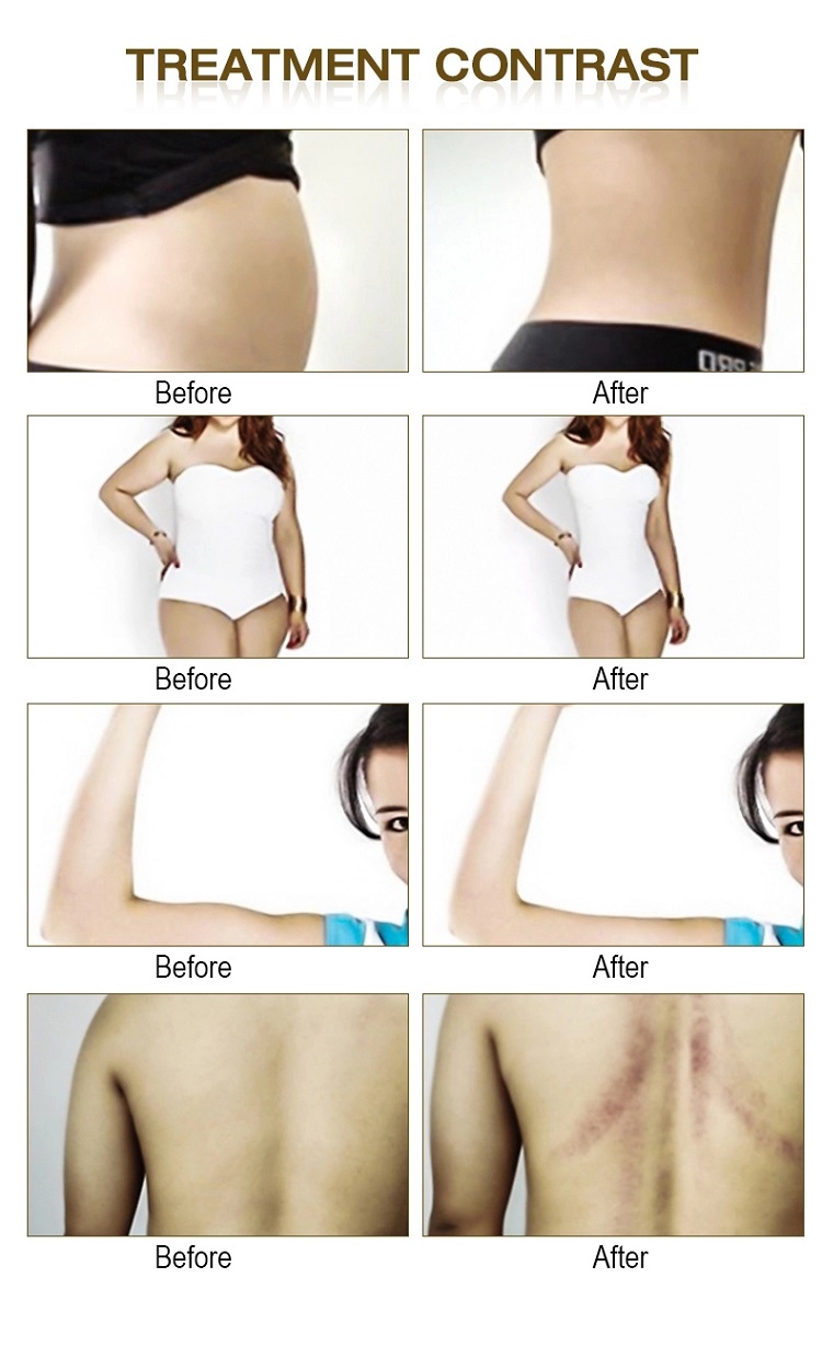 Portable 75W Black Color Body Massager Cavitation Vacuum Slimming Weight Loss Machine