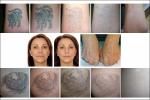 Salon Eyebrow Picosecond Laser Machine 755nm Permanent Tattoo Removal