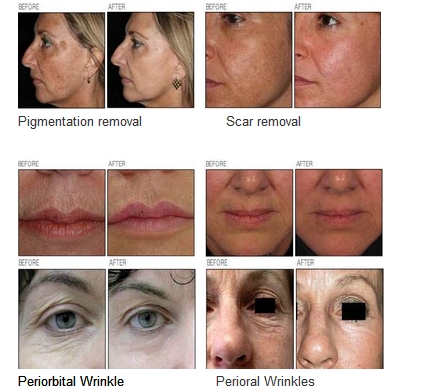 Fractional CO2 Laser Skin Rejuvenation Machine For Telangiectasis / Acne Scars Removal