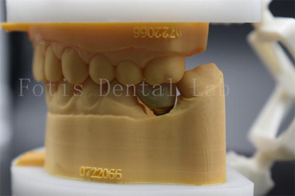 Buy cheap Long Lasting Polished Dental Lab Crowns Precision Fit Comfort For Patients from wholesalers
