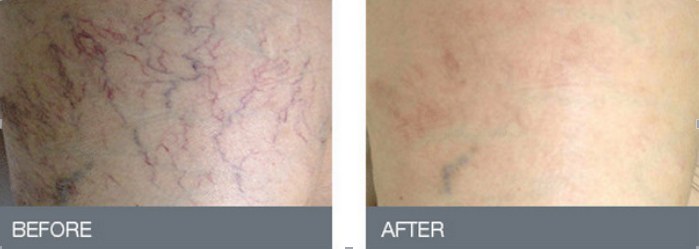 cheapest 980nm diode laser machines vascular removal spider vein diode laser 980nm