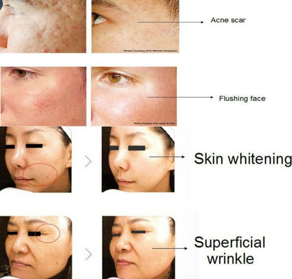 Buy cheap Home use RF skin tightening treatments from wholesalers