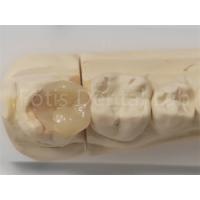 Buy cheap Aesthetic Inlay And Onlay In Dentistry For Indirect Filling And Tooth Restoratio product