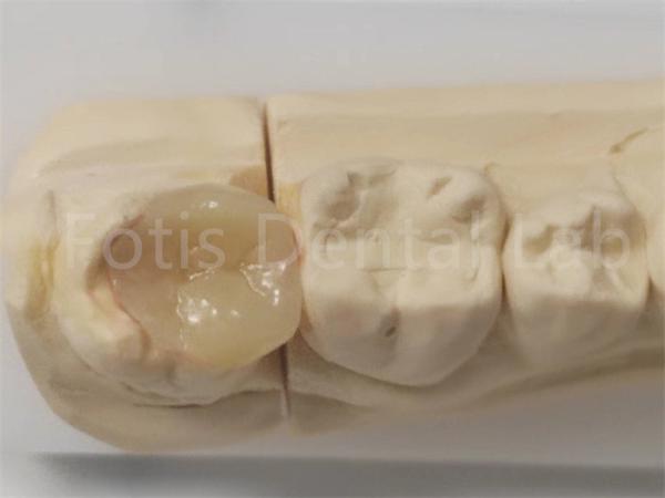 Buy cheap Aesthetic Inlay And Onlay In Dentistry For Indirect Filling And Tooth Restoration from wholesalers