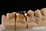Abrasive Resistance Dental Wax Casting FMC Crown For Oral Clinical Repair