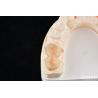 Buy cheap Natural Looking Dental Zirconia Inlays And Onlays High Esthetically Precise Fit from wholesalers