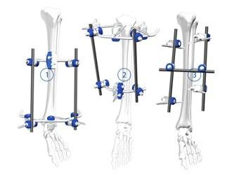 Buy cheap Flexible Orthopedic Trauma Implants Tibial Plateau Frame External Fixation from wholesalers