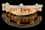 Titanium Static Guided Surgery Solutions For Implant Therapy Highly Accurate