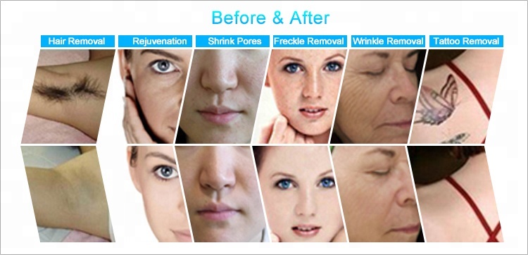 Opt E-Light Ipl Rf Nd Yag Laser Machine 4 In 1 Beauty Salon Equipment