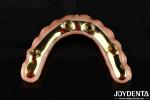 Comfortable To Wear Ti-Bar Restores Chewing Function Essential Ti-Bar Zirconia