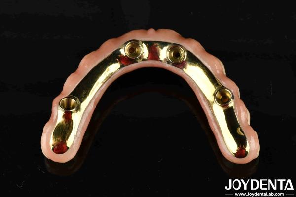 Comfortable To Wear Ti-Bar Restores Chewing Function Essential Ti-Bar Zirconia