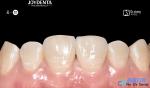 Secure Fit Porcelain Veneers Dental Treatment Composite Resin Veneers Stain