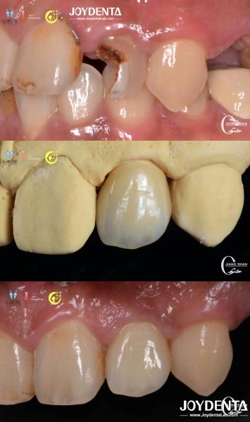 Buy cheap Lifelike Tooth Appearance Zirconia Bridges Dental Restoration Wear Resistant Customized from wholesalers