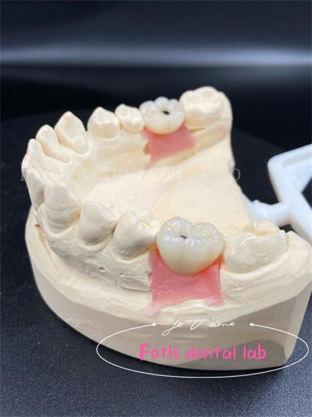 Buy cheap Customization Titanium/Ziconia/PFM Dental Lab Crowns Comfortable from wholesalers