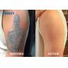 Buy cheap 532nm 755nm 1064nm Vertical Q Switch Picosecond Laser for Acne Removal from wholesalers