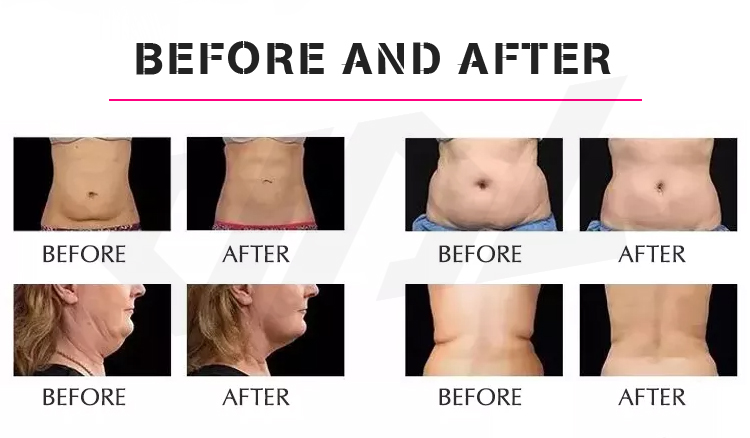 6 In 1 Ultrasound Anti-Wrinkle Vacuum Cavitation Body Shaper Rf Slimming Machine Skin Rejuvenation Skin Tightening As82
