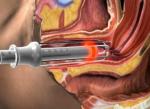 Coherent, USA RF Tube Fractional CO2 Laser Vaginal Tightening/wound healing
