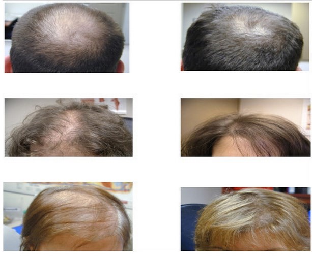 Biological Laser Hair Restoration Machine , LLLT Scalp Treatment Hair Growth Machine