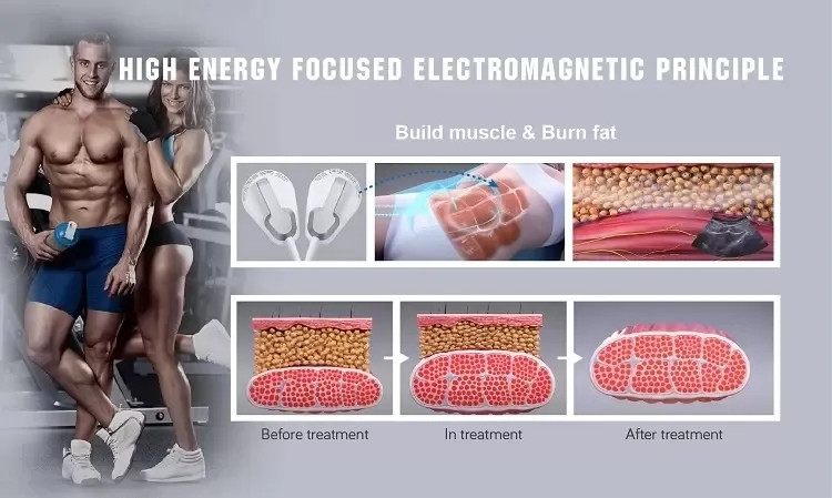 Body Muscle Sculptinging Machine Inner Ball Roller Neo RF Muscle Stimulator