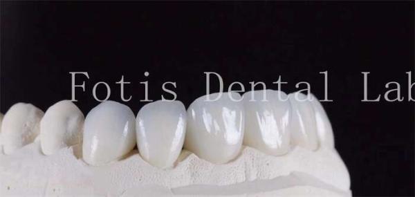 Buy cheap Ultra Strong Translucent Dental Laminate Veneers Natural Color from wholesalers