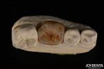 Custom Natural Looking Emax Dental Inlays And Onlays For Tooth Restoration