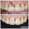 Buy cheap Smooth Surface Dental Tooth Zirconia Crown For Posterior And Anterior Restorations from wholesalers