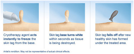 Best treatment for varicose and spider veins High frequency spider veins removal machine