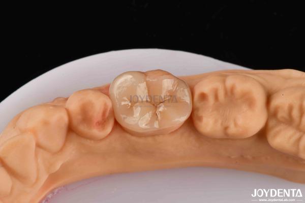 Buy cheap High Durability Dental Inlay Onlay Composite Natural Looking Appearance from wholesalers
