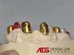 Dental Telescopic Crowns Prosthesis In Dentistry Customizable