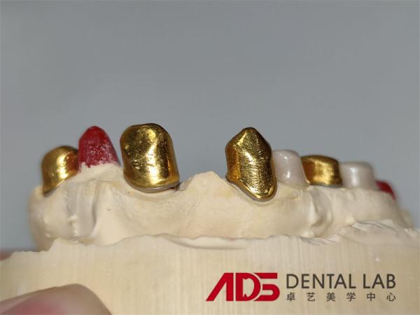 Buy cheap Dental Telescopic Crowns Prosthesis In Dentistry Customizable from wholesalers