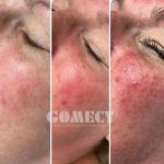 M22 Ipl Opt Machine Intense Pulsed Light For Hair Removal Skin Rejuvenation
