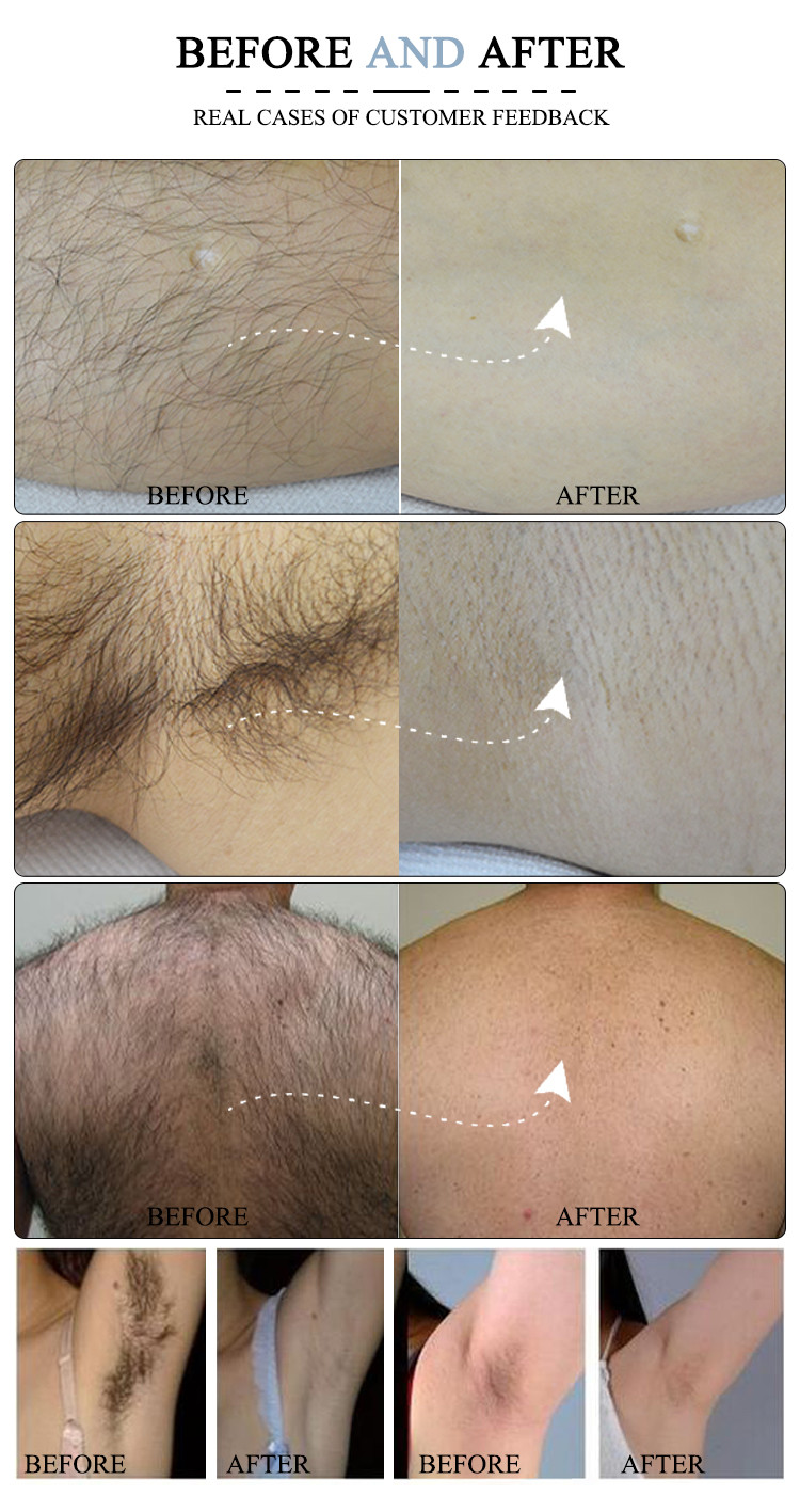 500W-2400W Commercial Clinic Salon Safe Contact Cooling Triple Wavelength Laser Hair Removal