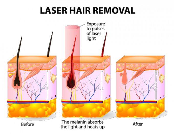 1200W High Power Diode Laser Hair Removal Machine Without The Risk Of Injury