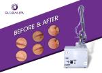Radio Frequency Fractional CO2 Laser Machine Far-infrared For Syringoma Removal