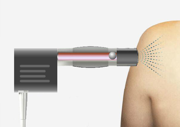 ESWT Shockwave Therapy for Penile Enhancement