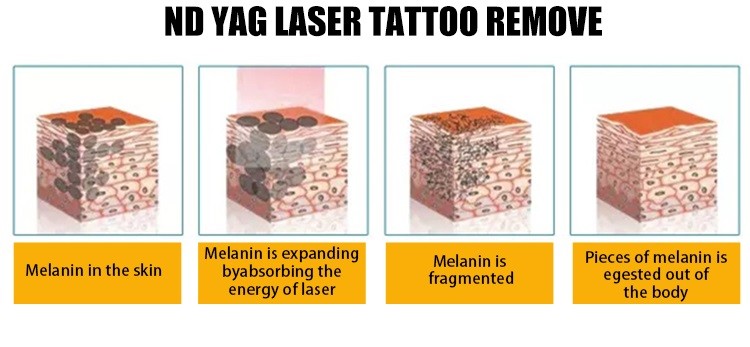 Q Switched ND Yag Laser Pigment Removal Machine 532nm 1064nm