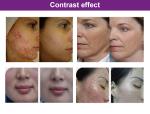 Pdt Light Therapy LED Therapy Equipment For Acne Treatment And Skin Whitening