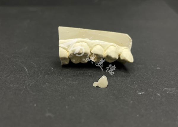 Hypoallergenic Stain-Resistant Emax Ceramic Inlay for Accurate Repair of Damaged