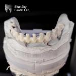 Pure Titanium Frame Malo Bridge Customizable Blue Sky Implant