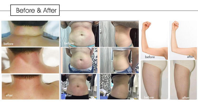 Cellulite Massager Body Sculpting Machine , Cellulite Vacuum Roller Machine