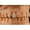 Buy cheap Customizable Metallic Material PFM Maryland Dental Care Oral Clinical Repair from wholesalers